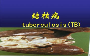 结核病防治演讲稿7篇