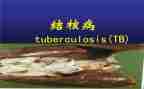 结核病防治演讲稿7篇